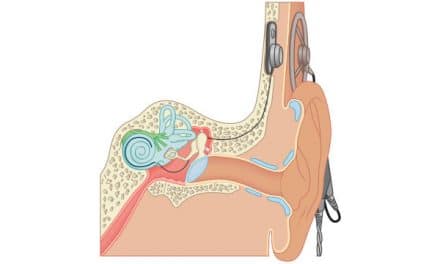 What is a cochlear implant and how to obtain one in the province of Quebec